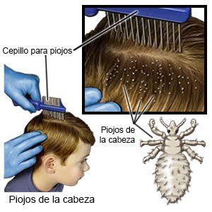 Piojos En La Cabeza De Los Niños Care Guide Information En Espanol