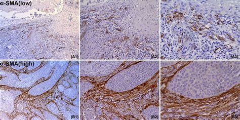 Heat Shock Factor In Cancerassociated Fibroblasts Is A Potential