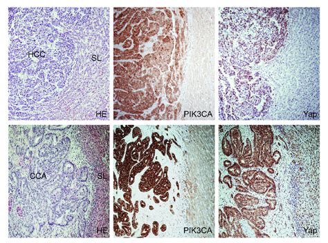 Immunohistochemical Patterns Of Pik3ca And Yap In Human Hepatocellular Download Scientific