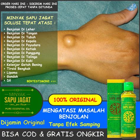 Obat Oles Benjolan Di Tubuh Leher Tangan Kaki Punggung Kepala Payudara