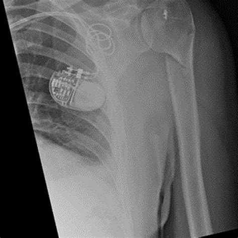 Lateral scapula (Y) view X-ray taken 6 weeks post-injury showing ...