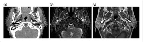 Chronic Adult Sialadenitis A Axial Computed Tomography CT Shows