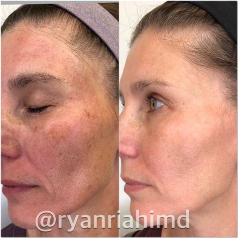 Intense Pulsed Light Ipl Before And After Photo Gallery Houston Tx