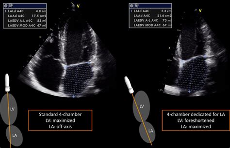 Left Atrial Volumes And Function By Three Dimensional Echocardiography Circulation