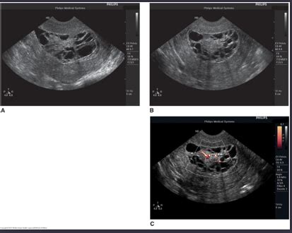 CH 9 Malignant Uterus Cervix Flashcards Quizlet