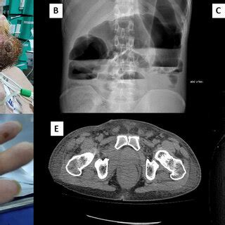 Ulcer lesions with a necrotic base and exophytic central crust on the ...