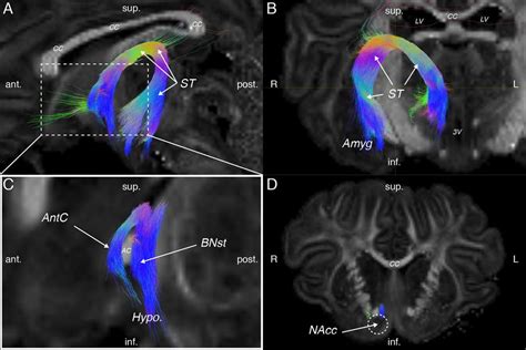 Tractography Of The Right Stria Terminalis ST Of JBG3 A B Are Not