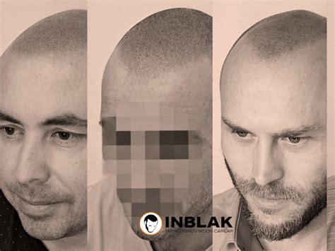 La importancia de la línea frontal en la micropigmentación capilar INBLAK