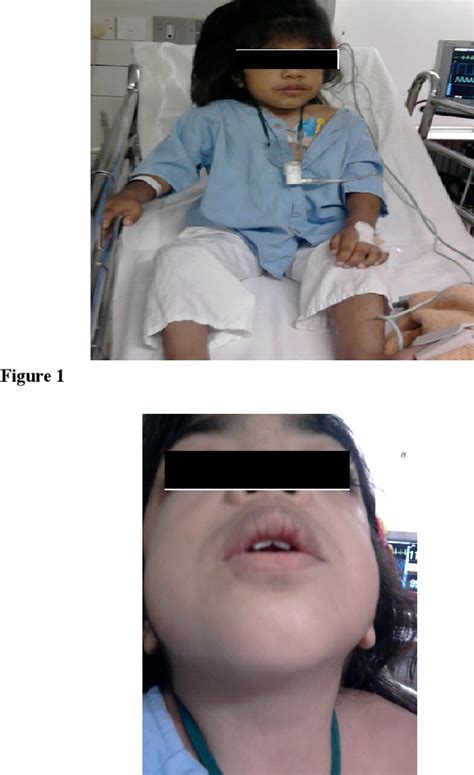 Figure 1 From Anaesthesia Challenges In A Patient With Hurler Syndrome A Case Report Semantic