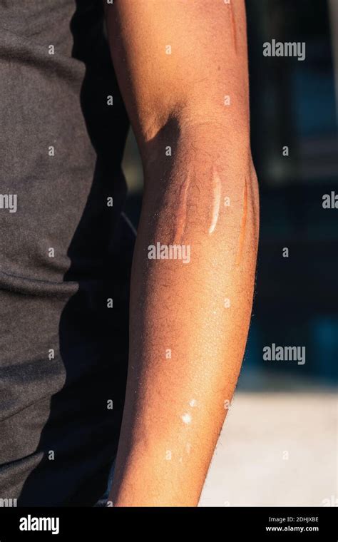 Scars of memory hi-res stock photography and images - Alamy