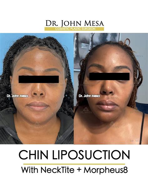 Chin Liposuction Before And After Photos Dr Mesa