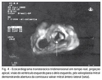 Scielo Brasil Ecocardiografia Tridimensional Em Tempo Real Da Valva