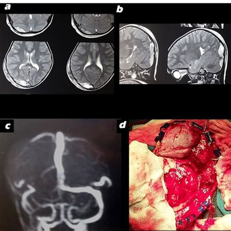 A Diastasis Of Coronal Suture B Extradural Hematoma From Midline C