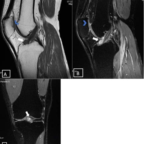 MRI Of The Left Knee Sagittal MRI Slices In T1 Weighted Sequence A