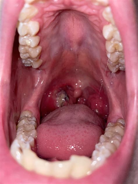 What Is This Thing On My Tonsil Soft Texture Attached To The Tonsil Accompanied With Swollen