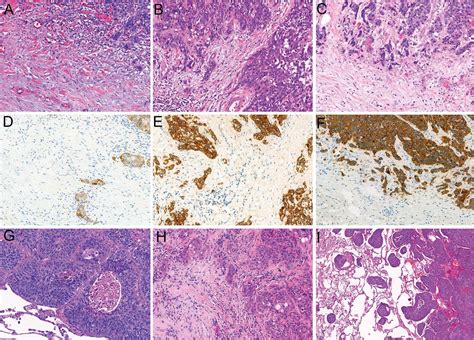 Validation Of The International Tumor Budding Consensus Conference