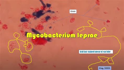 Mycobacterium Leprae Acid Fast