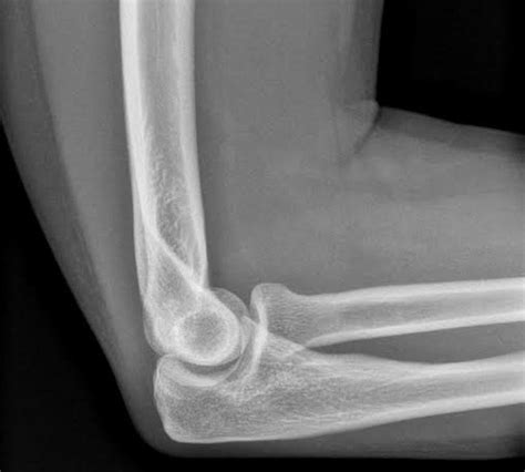 Normal Lateral Elbow Radiograph Radiology Case Radiopaedia Org