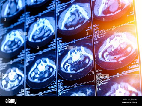 Computed Tomography Ct Scan Of Chest With Abdomen Stock Photo Alamy