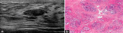 Fibroadenoma In Ectopic Breast Tissue Of Axilla A Rare Enti