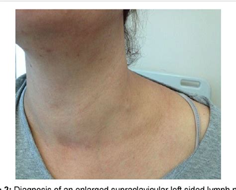 Supraclavicular Lymph Nodes