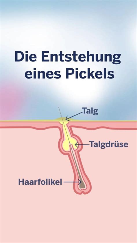 Wie Entsteht Ein Pickel Talgdr Sen Pickel Unreine Haut