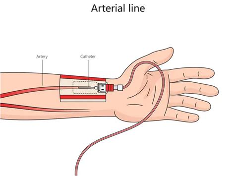 Central Venous Catheter Structure Diagram Hand Drawn Schematic Vector