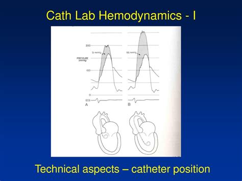 Cath Lab Hemodynamics I Pressure Tracings In The Diseased Heart Ppt Download