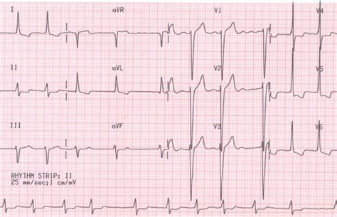 Left Ventricular Hypertrophy On Ecg