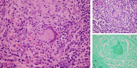 Fixed Cutaneous Sporotrichosis