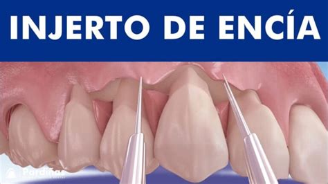 Cirugía para Encias Retraídas Cuál es el Costo Blog Dental Irriak