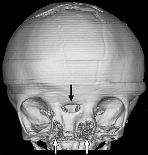 Before And After Surgery For Craniofacial Duplication Rmedizzy