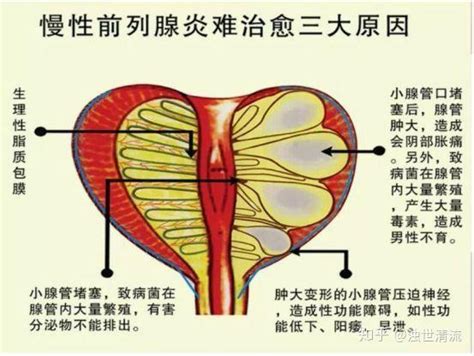 前列腺炎的治疗方法和经验 知乎