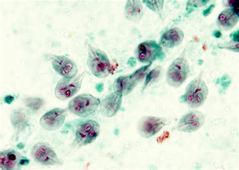 Pathology Outlines Giardia Lamblia