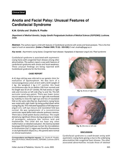 (PDF) Anotia and facial palsy: Unusual features of cardiofacial syndrome