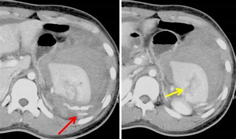 Blunt Abdominal Trauma Grade III Spleen Injury With Active Hemorrhage