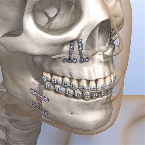 Class Ii Malocclusion With Clear Aligners How To Successfully Treat Your Patients