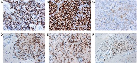 Letter Brain Invasion In Meningiomas—sex Associated Differe Neurosurgery