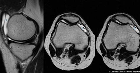 Dr Balaji Anvekar Frcr Medial Patellar Plica Syndrome