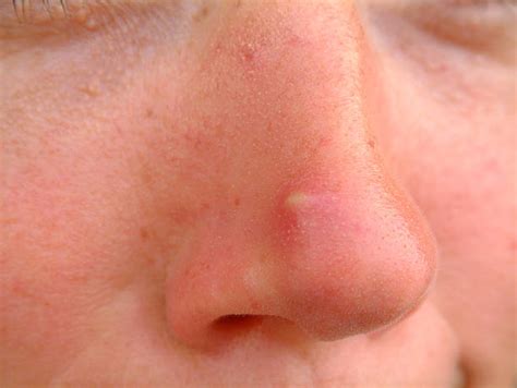 Nose Acne Scars Types Explained