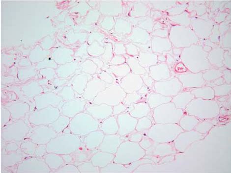 Core Needle Biopsy Of A Lipoma Like Portion Of A Well Differentiated