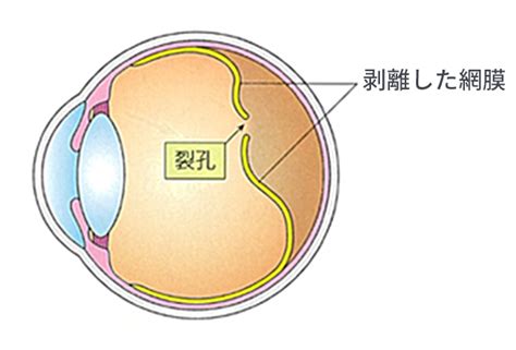 網膜剥離手術 下田眼科