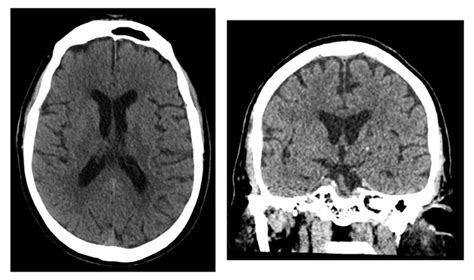 Research Looks At The Predictive Value Of Non Contrast Head Ct With