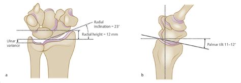 52 Distal Radius Osteotomy for Malunion (Volar Approach) | Plastic ...