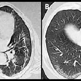 Axial A B Images Of Screening Hrct Of Two Different Patients From