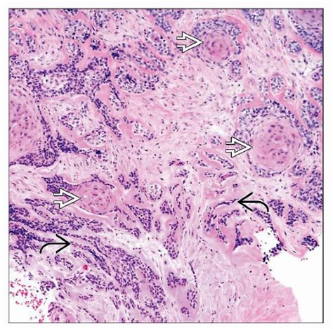 Squamoid Eccrine Ductal Carcinoma Basicmedical Key