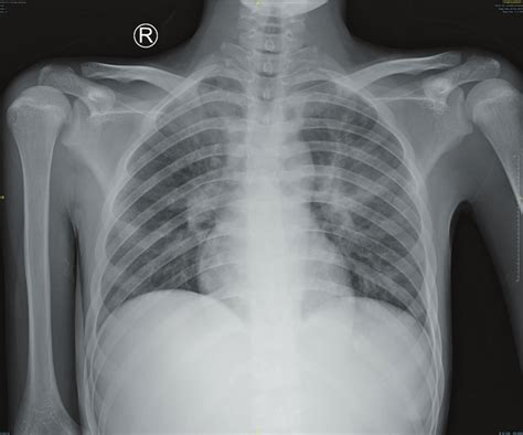 The chest X-ray examination revealed bilateral pneumonia. | Download ...