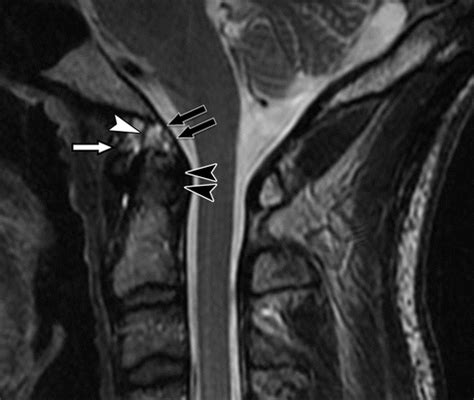 Atlanto Occipital Joint Xray