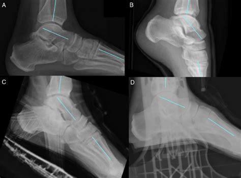 Lateral Radiographs Depicting A Typical Weightbearing Stance