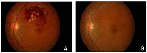 Left Eye Fundus Photo Showing Multiple Flame Shaped Retinal Hemorrhages Download Scientific